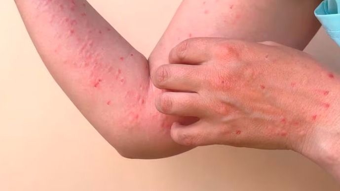 San Juan confirmó su primer caso de mpox del año y el paciente evolucionó sin internación